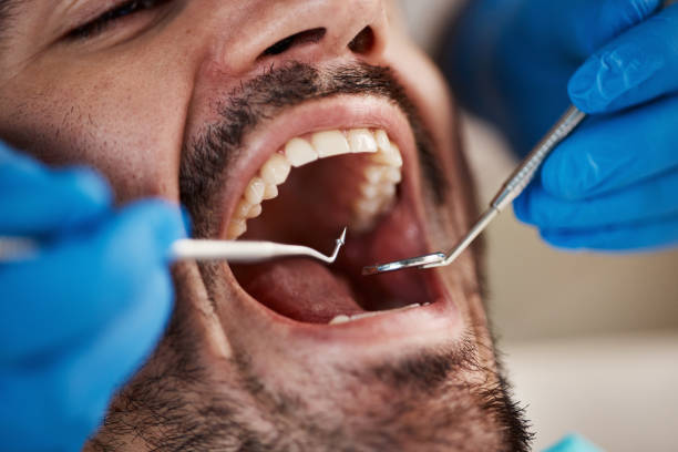 Best Emergency Dental Care for Abscessed Tooth in Redwood Valley, CA